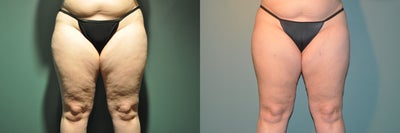 Cellulaze - 
	This patient underwent Cellulaze to her bilateral anterior thighs, bilateral lateral thighs, bilateral posterior thighs, and bilateral buttock.
