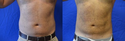 38 y/o male treated with SmartLipo Triplex to his abdomen/flanks - 38 y/o male who had a total of 1725 cc aspirated from his abdomen and flanks under local anesthesia in the office with the SmartLipo Triplex system.