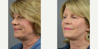 Woman treated with Facelift - These results from a recent facelift, blepharoplasty with fat repositioning case performed by facial specialists, Dr. James C. Marotta.
