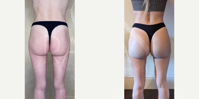 Woman treated with Butt Implants - Woman treated with Butt Implants