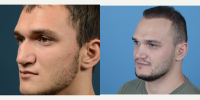 25-34 year old man treated with Rhinoplasty - Amazing change, amazing transformation