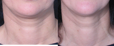 TriPollar - 
	Neck and double chin skin tightening after 4 treatments. Photos supplied by manufacturer, Pollogen Ltd, All Rights Reserved.
