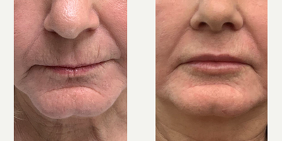 55-64 year old woman treated with Morpheus8, Restylane Silk - This client had great results with 3 sessions of Morpheus8 microneedling for skin tightening, and a 1/2 syringe of lip filler.