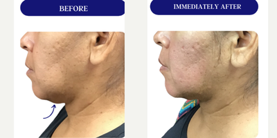 45-54 year old woman treated with Fractora RF, Forma, Facial, Skin Tightening, Skin Rejuvenation - FRACTORA FIRM-FORMAbipolar radiofrequency