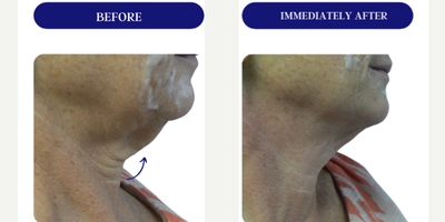 45-54 year old woman treated with Fractora RF, Forma, Facial, Skin Tightening, Skin Rejuvenation - FRACTORA FIRM-FORMAbipolar radiofrequency