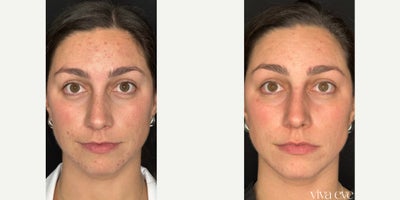 25-34 year old woman treated with Chemical Peel and Medical Grade Skincare to treat acne, hyperpigmentation, sun damage, and acn - 30 year old woman treated with Chemical Peel and Medical Grade Skincare to treat acne, hyperpigmentation, sun damage, and acne scarring