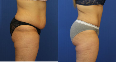 25-34 year old woman treated with Brazilian Butt Lift - 25-34 year old woman treated with Brazilian Butt Lift as well as Tummy Tuck