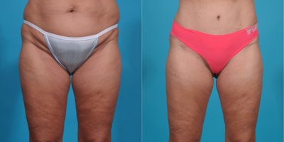 35-44 year old woman treated with Mini Tummy Tuck:  Low Bikini incision - Mini Tummy tuck with low short scar incision and muscle tightening