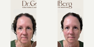 Woman treated with Nonsurgical Facelift - Woman treated with Nonsurgical Facelift