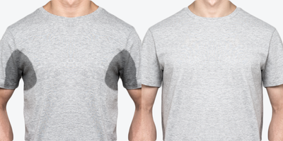 Excessive Sweating Treatment using Botox - Hyperhidrosis (excessive sweating) affects about 3% of the population (both men and women). This condition can be very embarrassing for some patients. Neuromodulators (botox) successfully treat excessive sweating for a specified period of time.