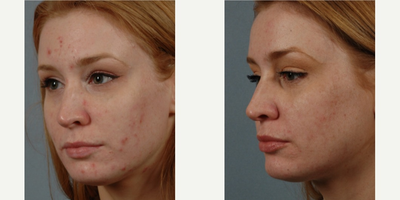 25-34 year old woman treated with Isolaz - Isolaz