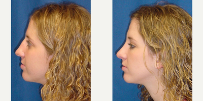 Woman treated with Rhinoplasty - Woman treated with Rhinoplasty