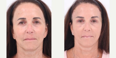 55-64 year old woman treated with Brow Lift, Eyelid Surgery - 58 year old patient is 3 weeks post Brow Lift and Upper Blepharoplasty.