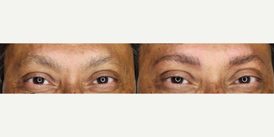 Woman treated with Microblading - Woman treated with Microblading