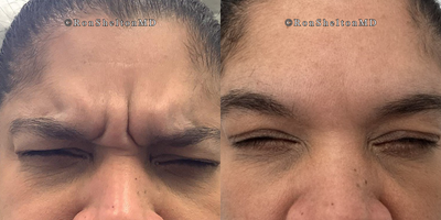 35-44 year old woman treated with Jeuveau, Skin Tightening - Jeuveau for frown lines: 3 Weeks after Jeuveau  with contraction