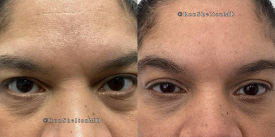 35-44 year old woman treated with Jeuveau, Skin Tightening - 3 weeks after Jeuveau  at rest. There is more skin visible above the eyelashes after the upper eyelids were pulled up
