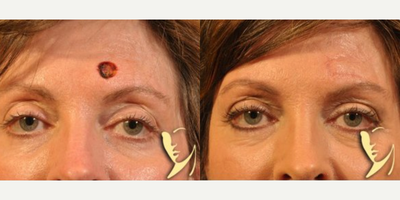 Woman treated with Mohs Surgery - Woman treated with Mohs Surgery