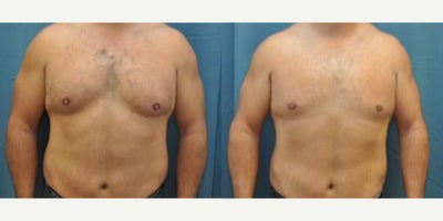 Man treated with Gynecomastia Surgery - Man treated with Gynecomastia Surgery