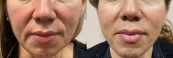 Woman treated with Dermal Fillers - Woman treated with Dermal Fillers