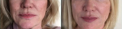 Woman treated with Profhil - Woman treated with Profhilo and medical peel course