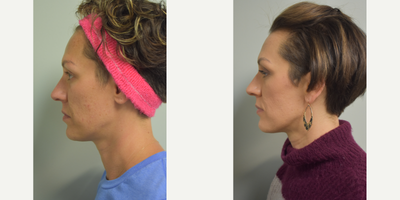 35-44 year old woman treated with Genius - Genius RF Micro-needling