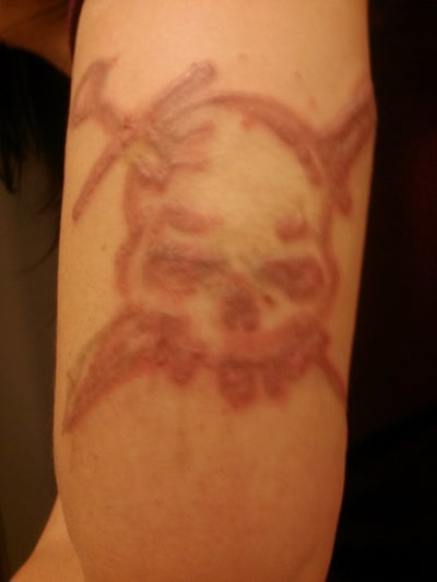 THE BEST 10 Tattoo Removal in WINSTON-SALEM, NC - Last Updated March 2024 -  Yelp