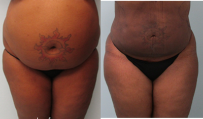 Lipo Only With Results Like A Tummy Tuck! - liposuction, tiny pinpoint scars, minimal 3 day downtime, easy recovery. by&nbsp;Dr. Gruber&nbsp;