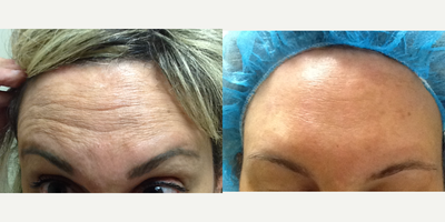 45-54 year old woman treated with ThermiSmooth - After one Botox treatment and 2 Thermismooth treatments