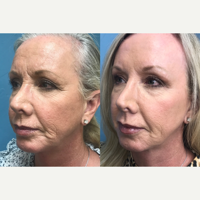 55-64 year old woman treated with Brow Lift, Eyelid Surgery, Chemical Peel - Patient had a Brow Lift, Upper eyelid lift and a chemical peel (Croton Oil Peel)
