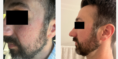 35-44 year old man treated with Revision Skincare - Rosacea