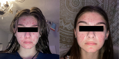 18-24 year old woman treated with Accutane - Accutane