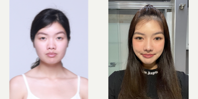 18-24 year old woman treated with Cheekbone Reduction - cheekbone reduction, jaw angle reduction, genioplasty, rhinoplasty, facial liposuction, double eyelid surgery