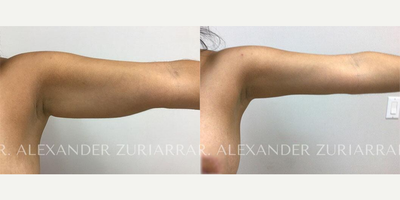 25-34 year old woman treated with Arm Lift - 25-34 year old woman treated with Arm Lift- 4 months post-op