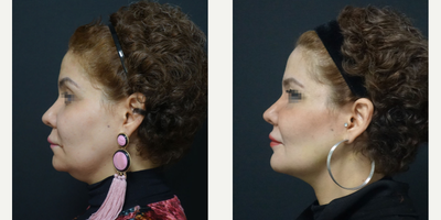 45-54 year old woman treated with Chin Liposuction - Facial Liposuction + Fat Transfer Surgery - 7 days post-op