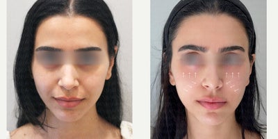 25-34 year old woman treated with Radiesse, Ellanse - This before and after result showcases a dual rejuvenation approach using Radiesse for nasolabial folds and Ellans for the under-eye area.Radiesse was applied to the nasolabial folds to provide structural support, soften deep smile lines, and improve overall facial contour. Its calcium-based formulation delivers immediate lifting while stimulating natural collagen production for long-term firmness.Ellans was used in the under-eye area to improve hollowing, fine lines, and skin quality. By stimulating collagen regeneration, Ellans helps restore a smoother, brighter, and more youthful under-eye appearance with gradual, natural-looking improvement.Together, this combination enhances facial balance, restores volume, and creates a refreshed, well-rested look.Results may vary depending on individual facial structure and skin condition.