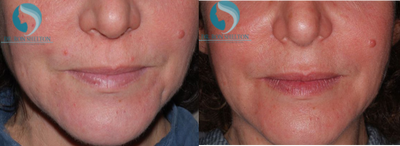 45-54 year old woman treated with ThermiSmooth - Generalized tightening desired to help this avid runner help reduce the sagging skin in her sun exposed face.