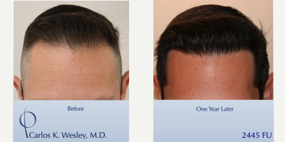 Patient treated with FUE Hair Transplant, Hair Loss Treatment, Hair Transplant - This 43-year-old man underwent a follicular unit extraction (FUE) session with Dr. Carlos K. Wesley in which a total of 2445 grafts were placed.