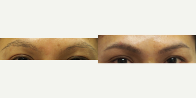25-34 year old woman treated with Eyebrow Transplant - 25-34 year old woman treated with Eyebrow Transplant