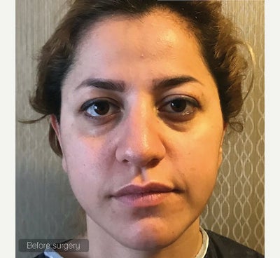 35-44 year old woman treated with Facial Fat Transfer - Facial Fat Injection
