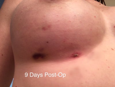 Bednar Cosmetic on X: Here's a Before & After of a Fat Transfer