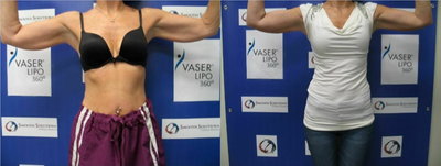 Woman treated with Skin Tightening - Woman treated with Skin Tightening.