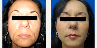 Woman treated with Belotero - Woman treated with Belotero.