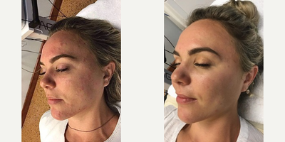 25-34 year old woman treated with Microneedling RF - (3) Agnes RF Treatments / 1 Month Post-Op