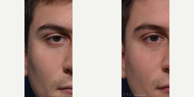18-24 year old man treated with Voluma, Restylane, Restylane Lyft, Restylane Defyne, Juvederm - A man in his 20s, after 1 session of Ezgel PRF to under eye hollows. This is typically done in a series of three sessions.