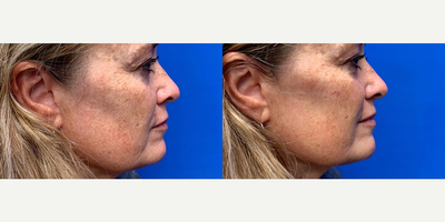 Woman treated with Voluma - Woman treated with Voluma