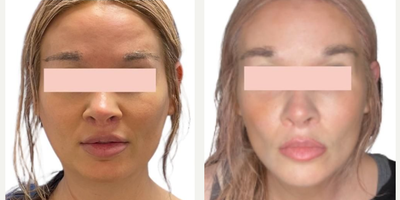 Woman treated with Jaw Surgery - Especially with a genioplasty, her jawline is now more defined and sculpted! Her overall appearance is tightened and lengthened, creating facial harmony and balance.