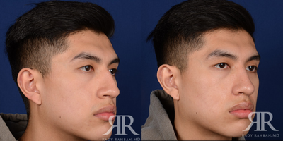45-54 year old man treated with Septoplasty, Rhinoplasty - Male Septoplasty & Rhinoplasty