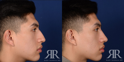 45-54 year old man treated with Septoplasty, Rhinoplasty - Male Septoplasty & Rhinoplasty