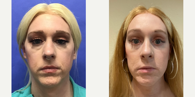 Patient treated with Cheek Augmentation - Cheek Implants (small) - 35 to 44 year-old female patient is 3 months post-op from Facial Feminization surgery. Her procedures included: Revision Forehead Lift and Orbital Bony Contouring, Septorhinoplasty with Cartilage Grafts and Weirs, Cheek Implants (small), Pre-Jowl Implant with Chin Reduction and Contour, Intranasal Lip Lift with Fat Augmentation, Thyroid Cartilage Shave and Voice FeminizationRevision Lower Eyelid Blepharoplasty (TC) with Fat Reposition and Fat Removal, Facelift/Necklift with Soft Tissue to Nasolabial Folds, TCA Peel - Lower Lids, and 1cc Juvederm to Perioral.