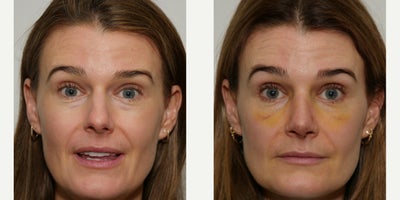 35-44 year old woman treated with Rhinoplasty, Septoplasty - Day 7 photos - 1-week post-operative photos showing mild bruisingThe profile photo also shows the computerized preoperative plan, then the actual post-op photo